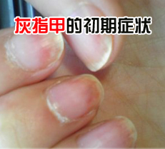 ��ָ�׵ĳ���֢״