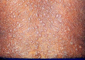 南昌治疗体癣疗效最好的医院是哪家