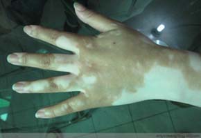 �����Ӱ�컼�ߵ��ź�