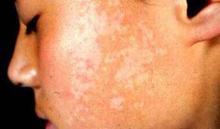 ���������֢״