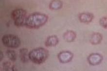 花斑癣不治疗的危害