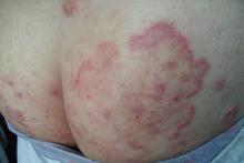 体癣有哪些危害