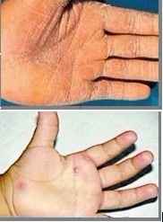 ��Ѣ�뺹����֢״�Ա�