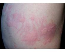 ݡ����֢״ͼƬ