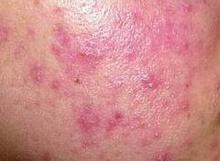 ����ٴ�֢״ͼʾ