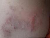 �괯���ٴ�֢״�������