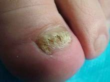 ��ָ�׵�֢״����