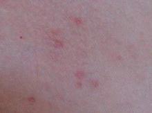 ��ѢͼƬ͸��֢״