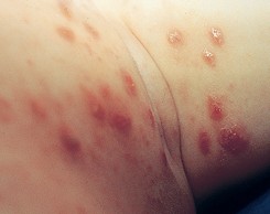 ��ϸ��˵�괯֢״ͼƬ