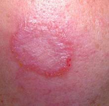 ��Ѣ������֢״����