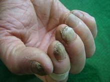 ��ָ��֢״ͼƬ