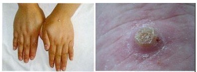 Ѱ����֢״ͼƬ