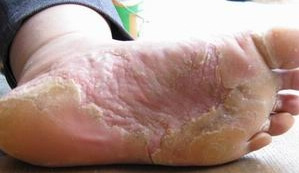手足癣照片 手足癣治疗