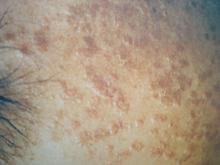 扁平疣早期症状表现