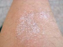 体癣愈合症状图片