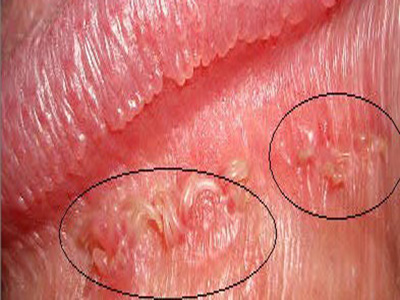 ����ʪ��֢״ͼƬ