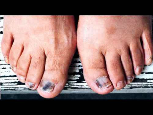 ��ָ�׳���֢״ͼƬ