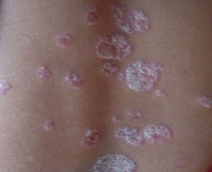 ţƤѢ�ĳ���ͼƬ֢״