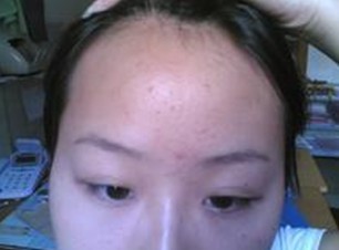 五种药物会加重青春痘呢?