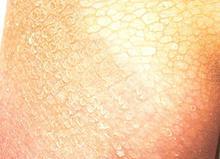 寻常型鱼鳞病的临床症状表现