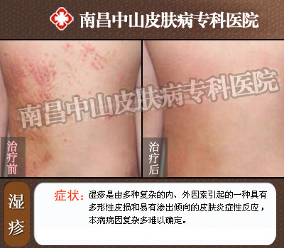 诱发湿疹的因素有哪些