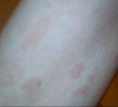 �Ӵ���Ƥ�׵ı����Լ�֢״