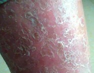 ţƤѢ������Ƥ����Ϊ����