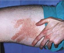 ѹ����ݡ�����֢״