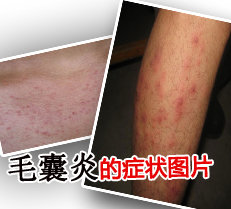 ë���׵�֢״ͼƬ