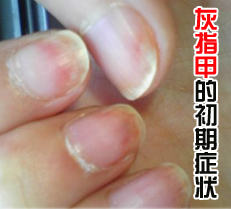 ��ָ�׵ĳ���֢״