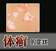 ��Ѣ��֢״ͼ