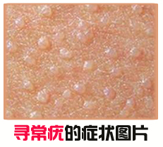 Ѱ�����֢״ͼƬ