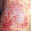 ʲô�ǽӴ���Ƥ�ף�