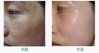 黄褐斑最佳治疗方法