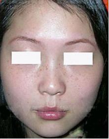 减少黄褐斑的方法