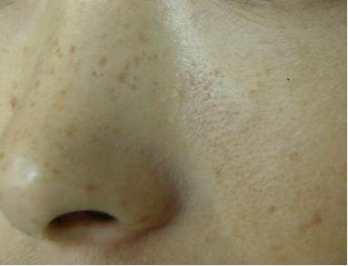 黄褐斑治疗方法