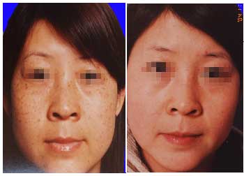 黄褐斑如何治愈