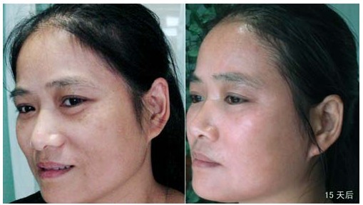 黄褐斑的去除方法