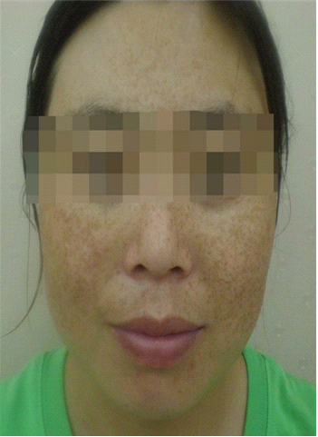 黄褐斑是什么样