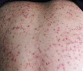 ����ë����֢״