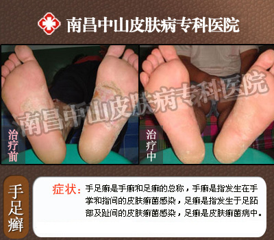 手足癣