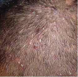 ͷ��ë����֢״