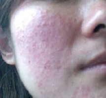 Ƥ�����������֢״