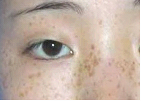 长黄褐斑的原因