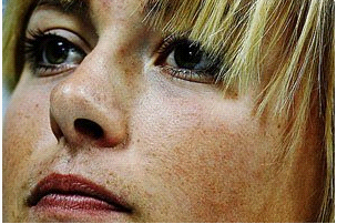 黄褐斑如何爬上脸