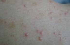 ����ë���״�Ⱦ��