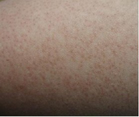 ë�ҹ��Ƚǻ�֢״