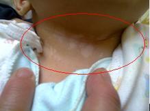 Ӥ�������֢״