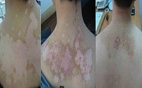 白癜风逐步治愈的症状