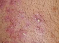 ����ë�ҽǻ�֢